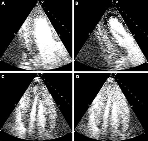 Stress echocardiography in coronary artery disease: a practical .